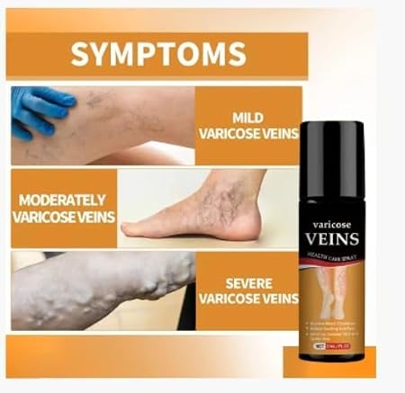 🩺 ~ Varicose Veins Health Care Spray 50ml (Pack of 2) ~ 🌿