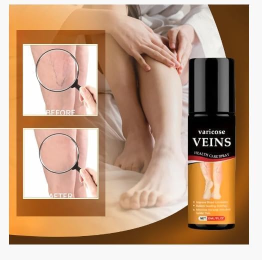 🩺 ~ Varicose Veins Health Care Spray 50ml (Pack of 2) ~ 🌿